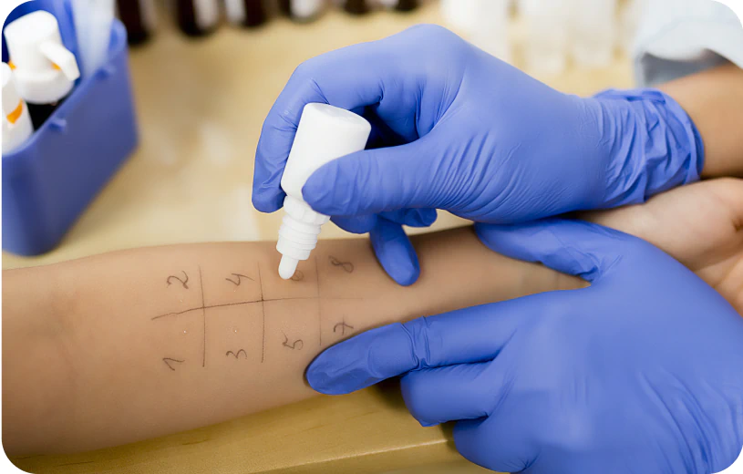 Gloved hand applying allergy treatment to arm