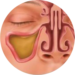 balloon-sinuplasty-step1