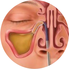 balloon-sinuplasty-step2