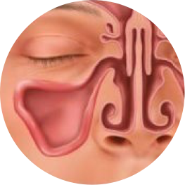 balloon-sinuplasty-step3