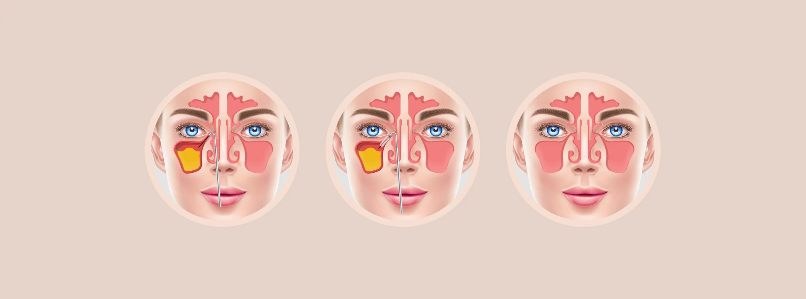 Illustration of Balloon sinuplasty tool